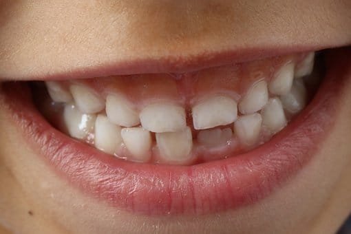 Teeth in Kids
