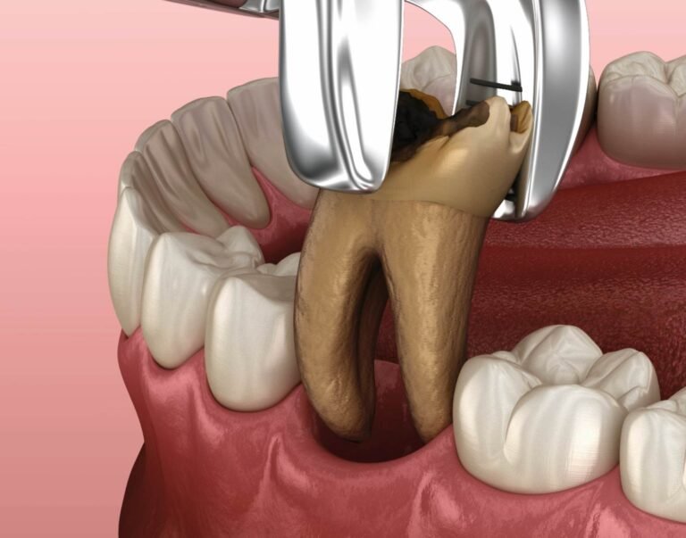 Tooth Extraction cost