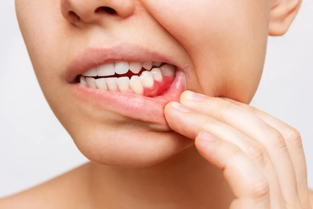 हिरड्यांचे आजार Gum Diseases
