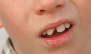 Fractured Tooth
