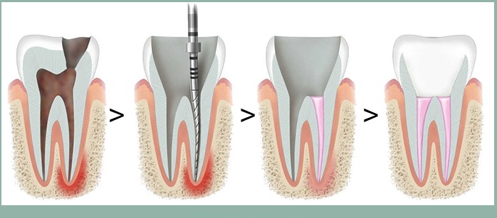 Root Canal Treatment Steps 